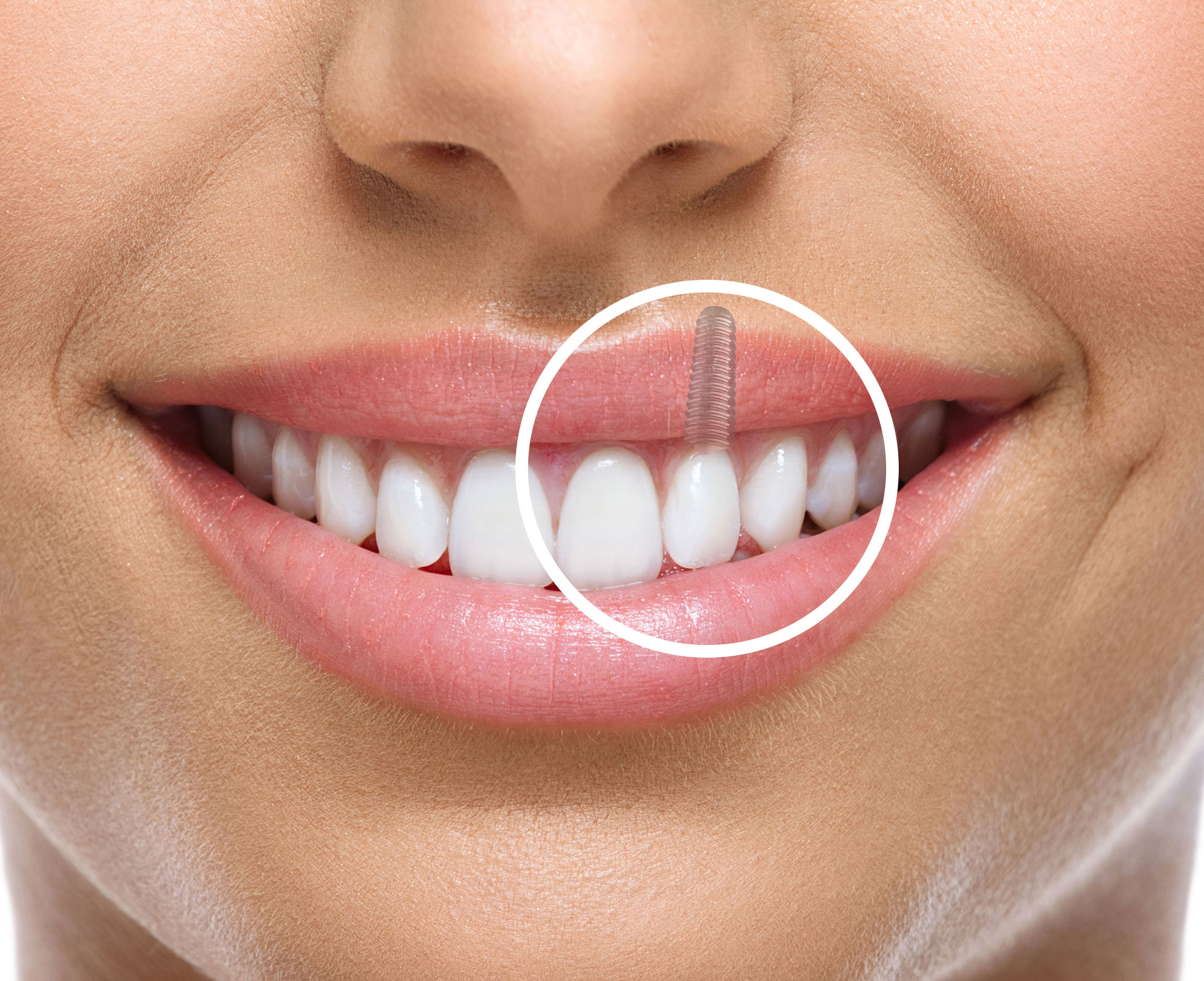 Dental implant — natural-looking permanent tooth replacement
